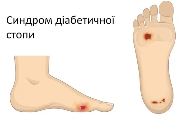 діабетична ступня